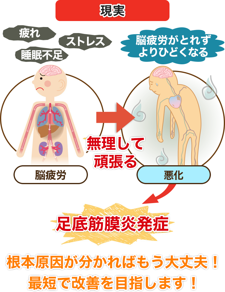 足底筋膜炎が病院やインソールで改善しなければ 骨盤王国 新宿西口整体院