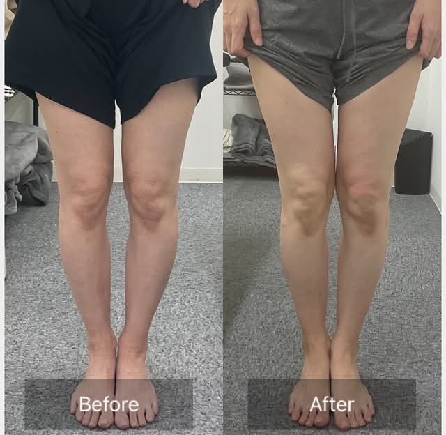 O脚　ビフォーアフター